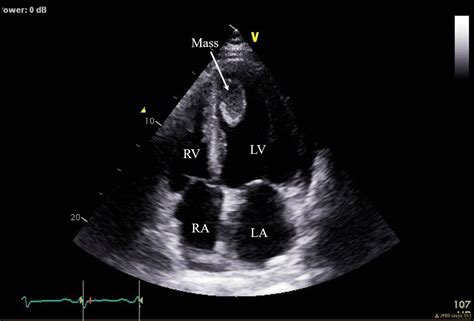 cs echo lv mass